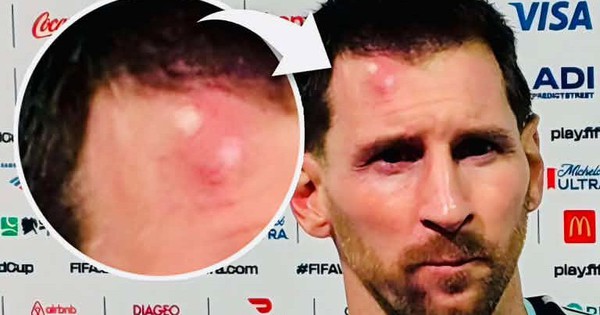 Messi sưng vêu trán sau trận thắng Cabo Verde: Vì sao nên nỗi? - hình ảnh - okvipjl.com Messi sưng vêu trán sau trận thắng Cabo Verde: Vì sao nên nỗi? - hình ảnh - okvipjl.com